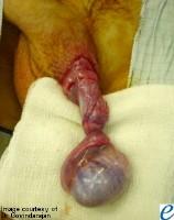 Testicular Torsion Teenage boys May occur from strenuous exercise or injury, or no apparent