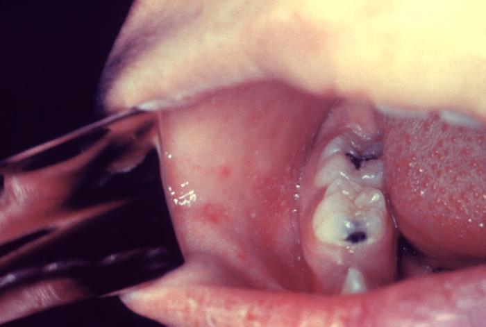 Measles Resurgence Pathognomonic enanthema: Koplik spots on the buccal mucosa 14 days after exposure: rash Infectious 4