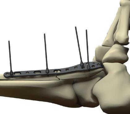 STEP Foot & Ankle Solutions Surgical Technique 1. Articular Reduction Fibular length, alignment and rotation should be restored precisely.