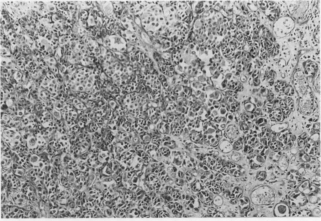 A similar pattern is seen adjacent to similar infiltrates in dysplastic naevi. 4f. Fig 4 Secondary melanoma.