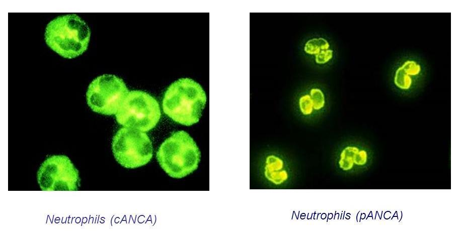 ANCA Anti neutrophil cytoplasmic antibodies C-ANCA ( Cytoplasmic staining pattern) Antibodies to PR -3 What is PR- 3?