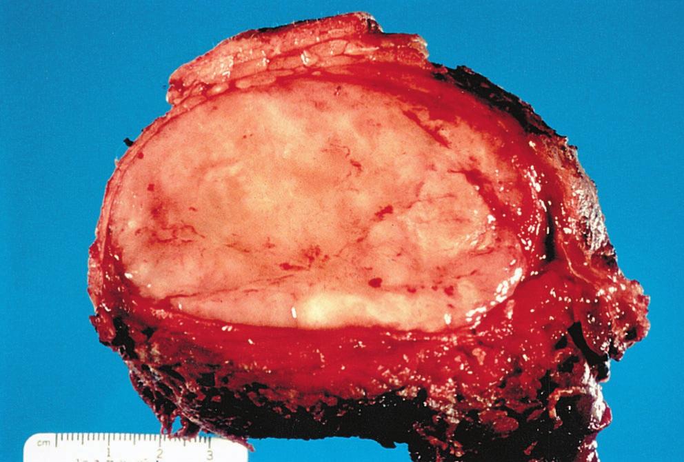 FIGURE 1. Gross appearance of a pleomorphic liposarcoma arising in the deep soft tissues of the upper arm of an 87-year-old male. FIGURE 3. MFH-like area of a pleomorphic liposarcoma.