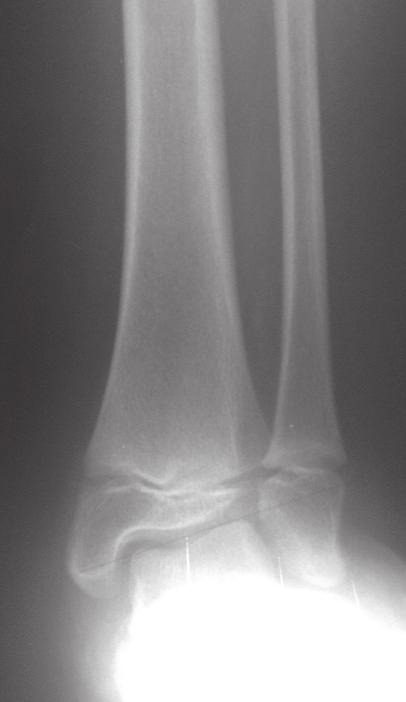This is determined by measuring the angle created by the intersection of the central axis of the tibia and a second line drawn across the epiphyseal surface of the distal tibia.