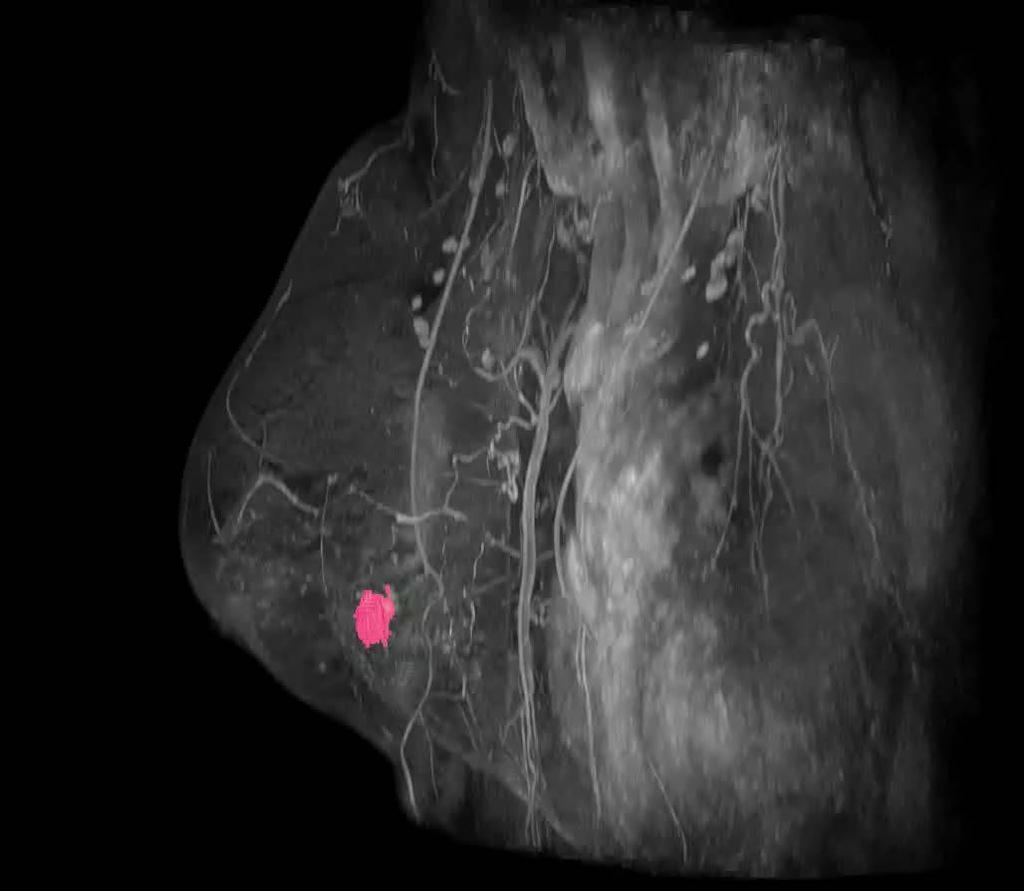 Computer-extracted Breast Cancer on MRI