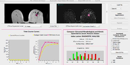University of Chicago High-Throughput MRI Phenotyping System For Breast Tumors 4D DCE MRI images Radiologist-indicated Tumor Center Computerized Tumor