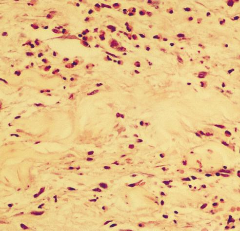 Dense dermal eosinophilic infiltrate (H&E, 400, Case 2). cell count demonstrated mild leukocytosis (12.2 109/L, normal range [4.4-10.