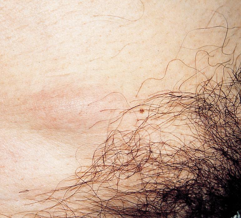 Skin biopsy revealed a diffuse inflammatory infiltrate consisting mainly of eosinophils with edema in the whole dermis (Fig. 2).