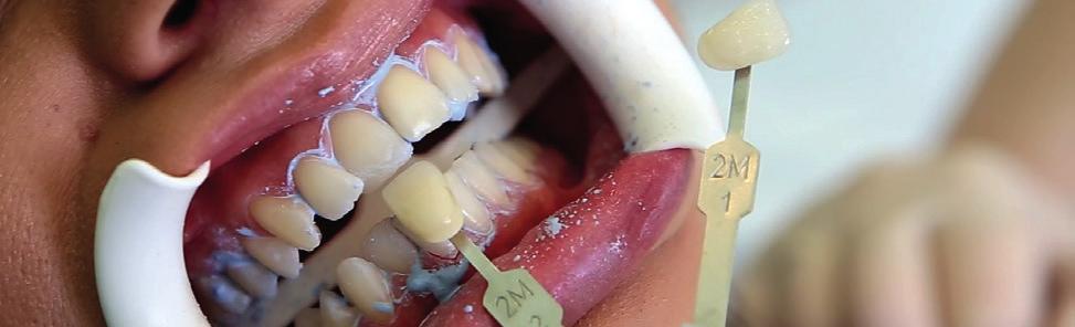 Application of gingiva protection After inserting a lip and