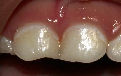 management. Enamel defects are associated with substantially increased risk of ECC.