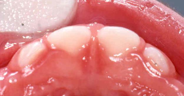 is at high risk for caries and should be referred to a dentist for further