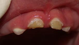 Early Aggressive ECC 14 Appearance & Symptoms Abscesses and fistulae may be present