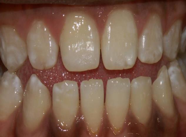 Fluorosis 25 Appearance and Significance White mottling of teeth due