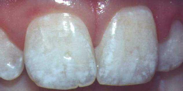 Cosmetic issue that does not affect systemic health Moderate Fluorosis