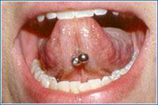 Adolescence - Oral Piercings 37 Procedure-related Risks Swelling most common symptom post-piercing Prolonged bleeding, nerve damage Infection Skin or oral