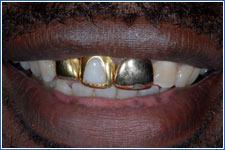 Adolescence - Grills 38 Grills on the teeth can increase the risk of