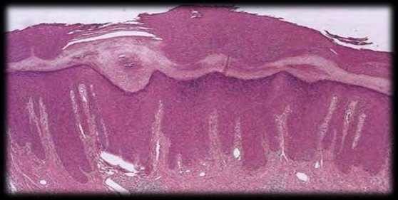 Histopathology Compact hyperkeratosis Irregular acanthosis Hypergranulosis Perivascular lymphocytic infiltrate