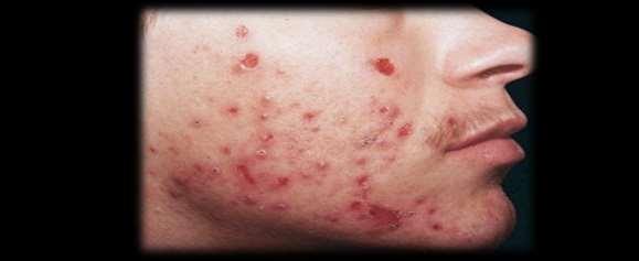 Acne Excoriee Scratching and picking acne lesions