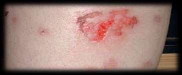 Dermatitis Artefacta Clinical Usually within reach of hands Unusual shapes If chemical is used-red streaks/guttate marks seen beneath the principle patch where the chemical