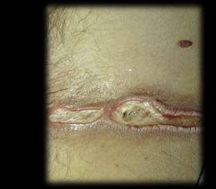 Pathology Not diagnostic Dermatitis Artefacta Erosion, ulceration, hyperkeratosis, vascular proliferation,