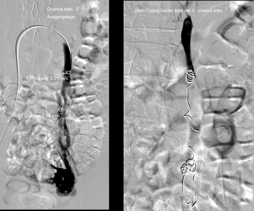 EMBOLIZATION AND STENTING Performed