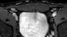 Conclusion MR and CT venography provide detailed 3D anatomy for planning of intervention and complication management.