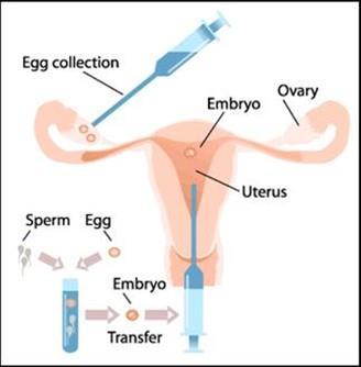 Lack of ovulation: Some women do not ovulate (release an egg) Doctors can give them FSH It stimulates the eggs in the ovaries to mature and also release oestrogen Then the doctor can give LH to cause
