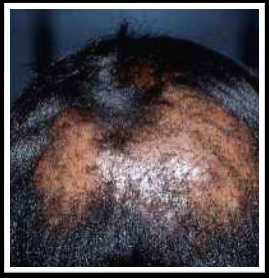 Central Centrifugal Scarring Alopecia Progressive scarring alopecia on the vertex of the scalp but does not assume a particular cause Cicatricial and Scarring frequently used interchangeably