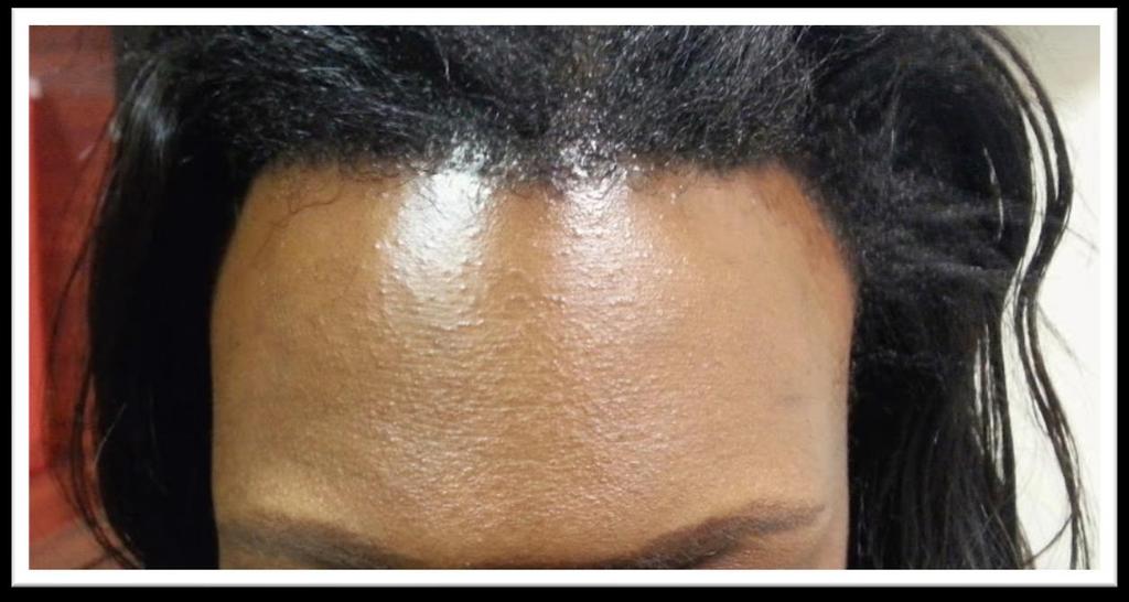 Frontal Fibrosing Alopecia Hair loss on the frontal hairline, and may also cause hair loss in other areas such as the eyebrows or axilla