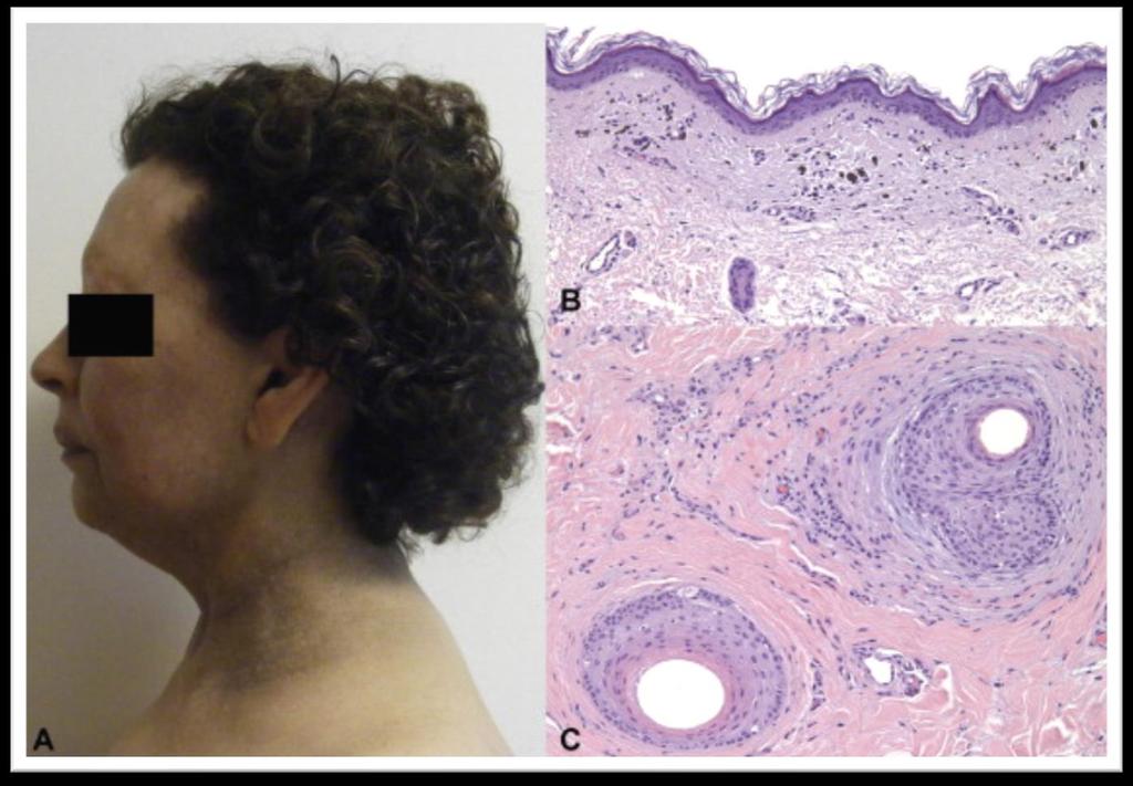 Frontal Fibrosing Alopecia associated with Lichen Planus pigmentosus A, Lichen planus pigmentosus and frontal fibrosing alopecia.