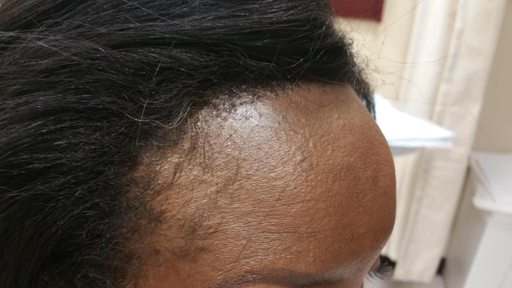 Scarring alopecia stable with