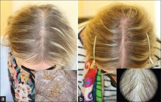 Alopecia and seborrheic-like dermatitis in a patient with biotin