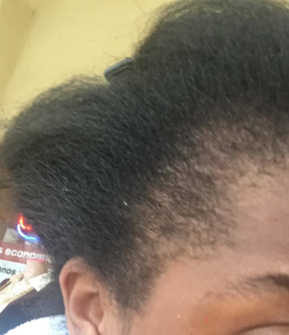 Traction alopecia: Before and