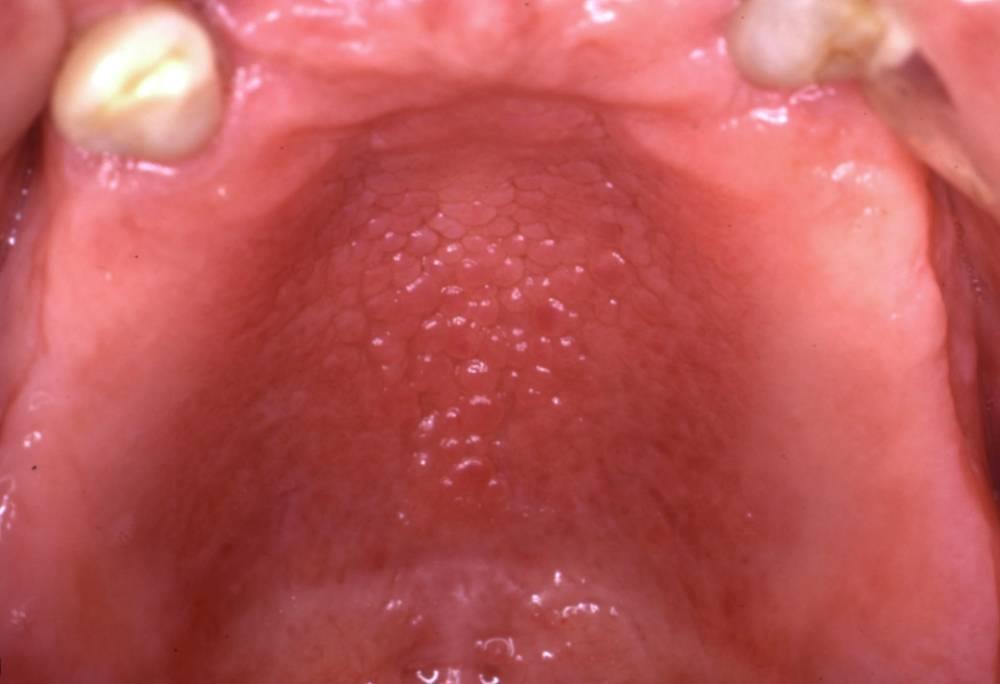 papillary hyperplasia presents as a collection of small, rounded, soft tissue growths (Fig 8). Individual growths are separated by distinct crevices. Fig 8.