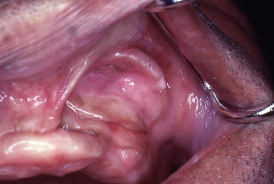 Fig 9. Epulis fissuratum (arrows) is a hyperplastic growth caused by an ill-fitting or overextended denture base. If an epulis has developed at a denture border, its consistency should be determined.