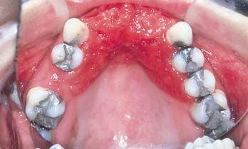 Denture stomatitis Denture stomatitis is characterized by generalized erythema that affects the soft tissues covered by a prosthesis (Fig 10).