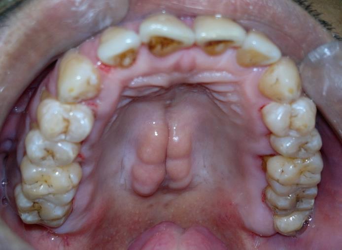 Soft tissue displacement Displacement of the soft tissues underlying ill-fitting or poorly designed removable partial dentures occurs frequently.