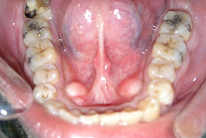 Fig. 11 Mandibular tori are exostoses on the lingual surface of the mandible. In most instances, mandibular tori occur bilaterally.