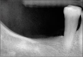 Tooth mobility caused by a loss of osseous support is not reversible in most instances.