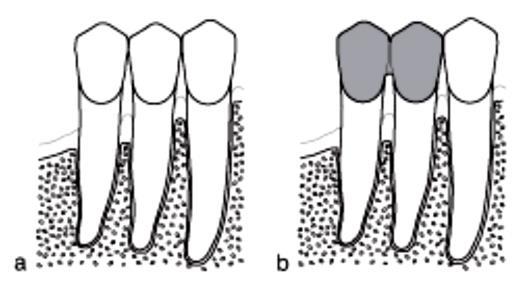 Fig 5. (a) In this diagram, the premolars exhibit compromised periodontal support. (b) By splinting these teeth with a fixed restoration, it may be possible to provide improved support. Fig 6.