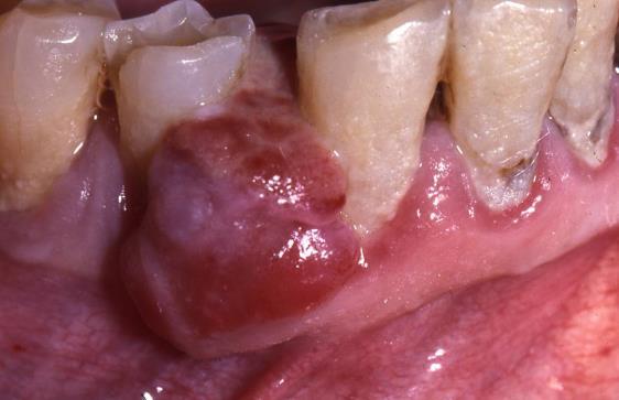 Fig. 7 The clinical examination must disclose the presence of periodontal pockets, inflammation, infection, furcation involvement(s), and the absence of sufficient attached gingiva.