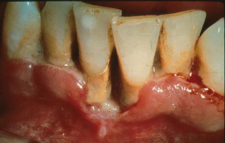 patient to preserve this state of health. Periodontal therapy that falls short of this objective may compromise the prognosis of prosthodontic treatment.