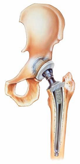 Hip and Knee Arthroplasty: Maximizing FRIDAY, MARCH 8, 2013