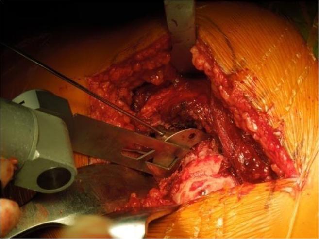 Yang et al. BMC Surgery (2015) 15:29 Page 3 of 6 in hip replacement.