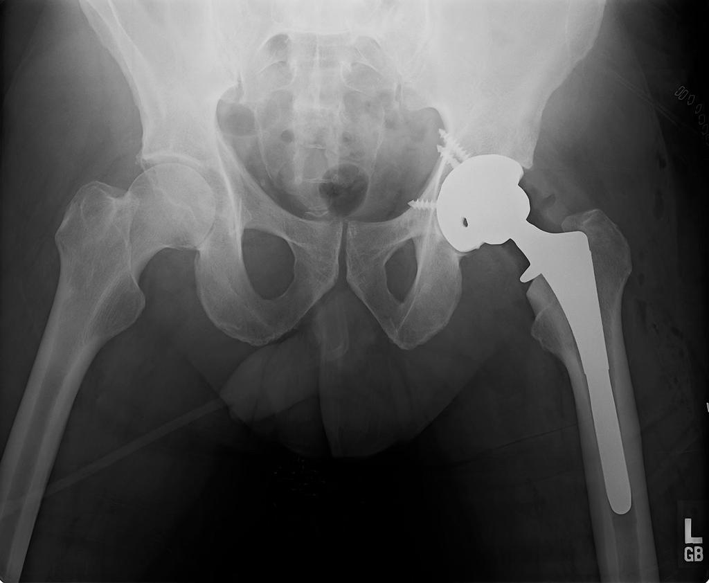 Leg Length Discrepancy in TKA and THA On July 20, 2011 the patient underwent uneventful left total hip arthroplasty through a posterior Kocher-Langenbeck approach, and limb length was established on