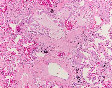 But small airways Goblet Cell metaplasia and Mucostasis would seem to be the major histopathology abnormalities.