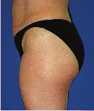 Cellulite usually a c c u m u l a t e s i n t h e abdomen, thighs and buttocks regions.