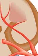 Bisected Kidney major calyx renal