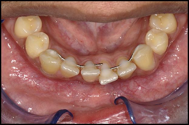 278 Shaughnessy, Proffit, and Samara Fig 1. Dead soft wire with breakage between the central incisors, resulting in movement of 2 segments of teeth.
