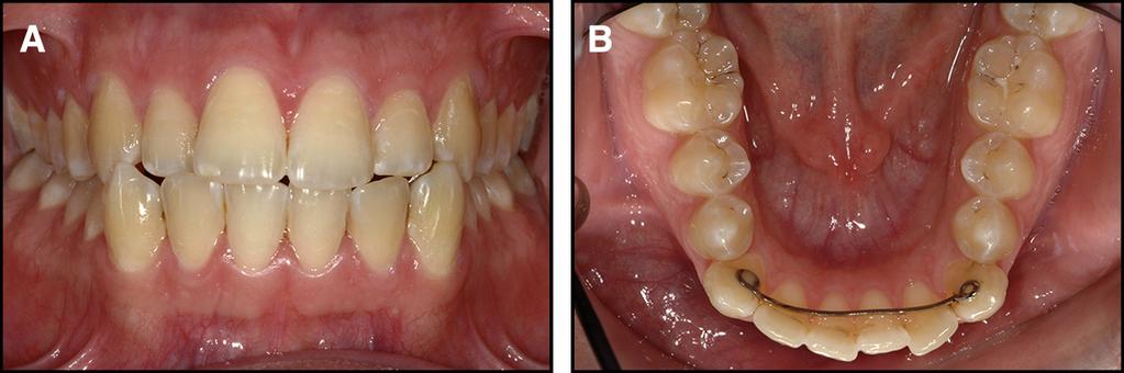 canine, and torque of the right lateral incisor and central incisor in opposite directions: A, buccal view; B, occlusal