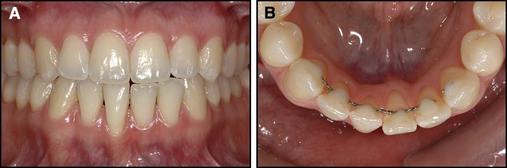 280 Shaughnessy, Proffit, and Samara Fig 7. Flexible spiral wire retainer with torque discrepancy between the left and right incisors: A, frontal view; B, occlusal view.